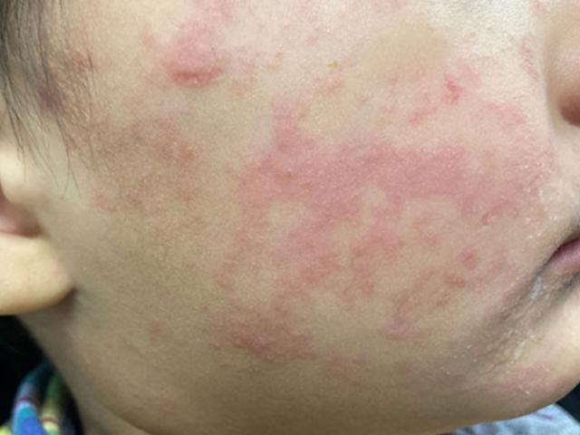 Centers for Disease Control and Prevention The child’s cheek shows the characteristic rash associated with measles.