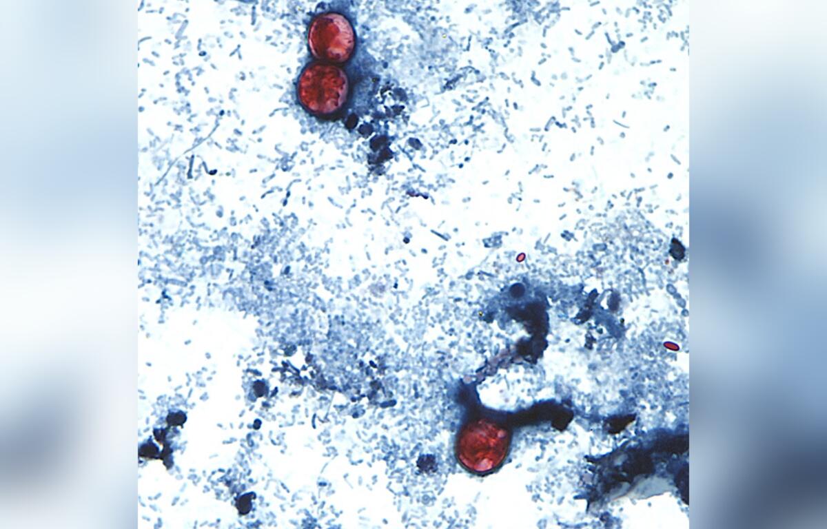 This undated photo taken through a microscope provided by the CDC shows Cyclospora cayetanensis oocysts found in a fresh stool sample which had been prepared with a formalin solution and stained with safranin. (CDC via AP)