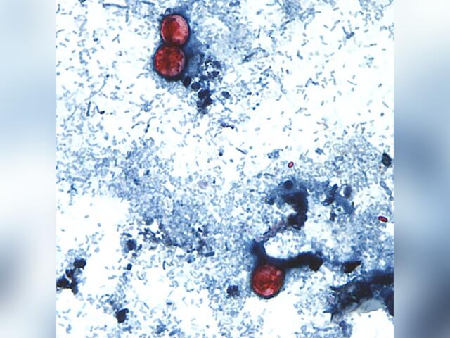 This undated photo taken through a microscope provided by the CDC shows Cyclospora cayetanensis oocysts found in a fresh stool sample which had been prepared with a formalin solution and stained with safranin. (CDC via AP)